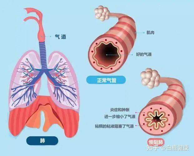 支气管扩张剂糖皮质激素_糖皮质激素扩张气道的作用机理_糖皮质激素和支气管扩张剂治疗